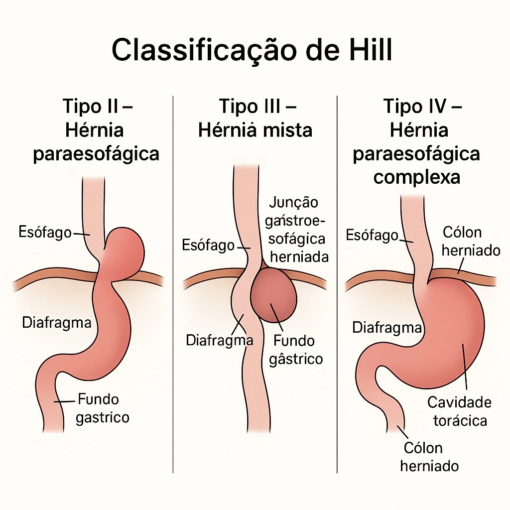 Classificação de Hill para a Hérnia de Hiato